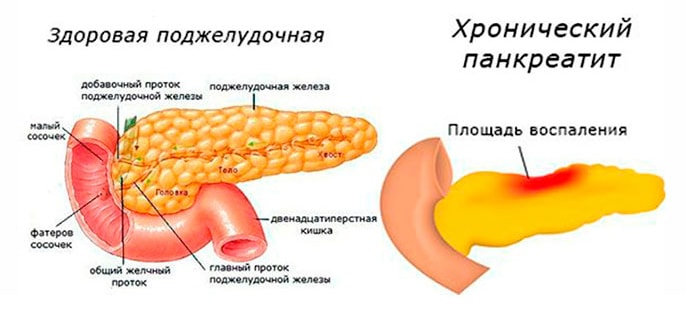 Как предотвратить панкреатит: полезные рекомендации