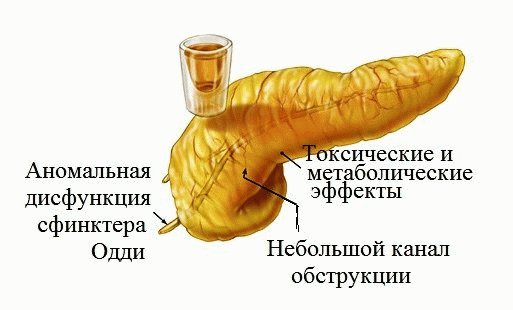 Панкреатит и алкоголь: опасная связь