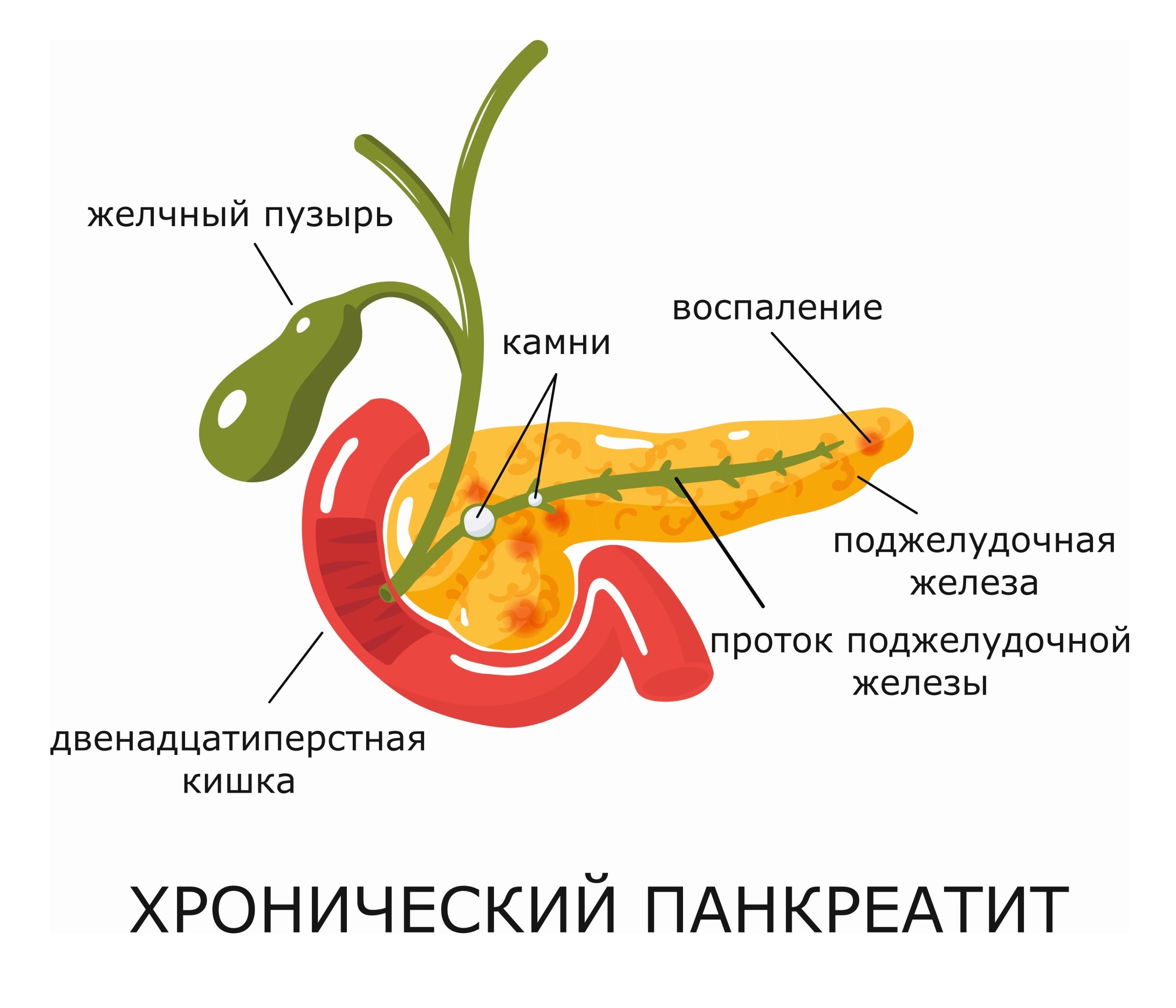 Панкреатит: как избежать обострений?