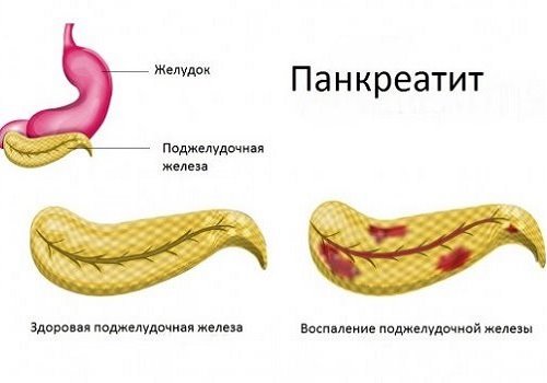 Панкреатит: какие упражнения помогают укрепить поджелудочную железу