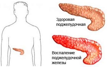 Панкреатит и нарушения пищеварения: взаимосвязь и лечение
