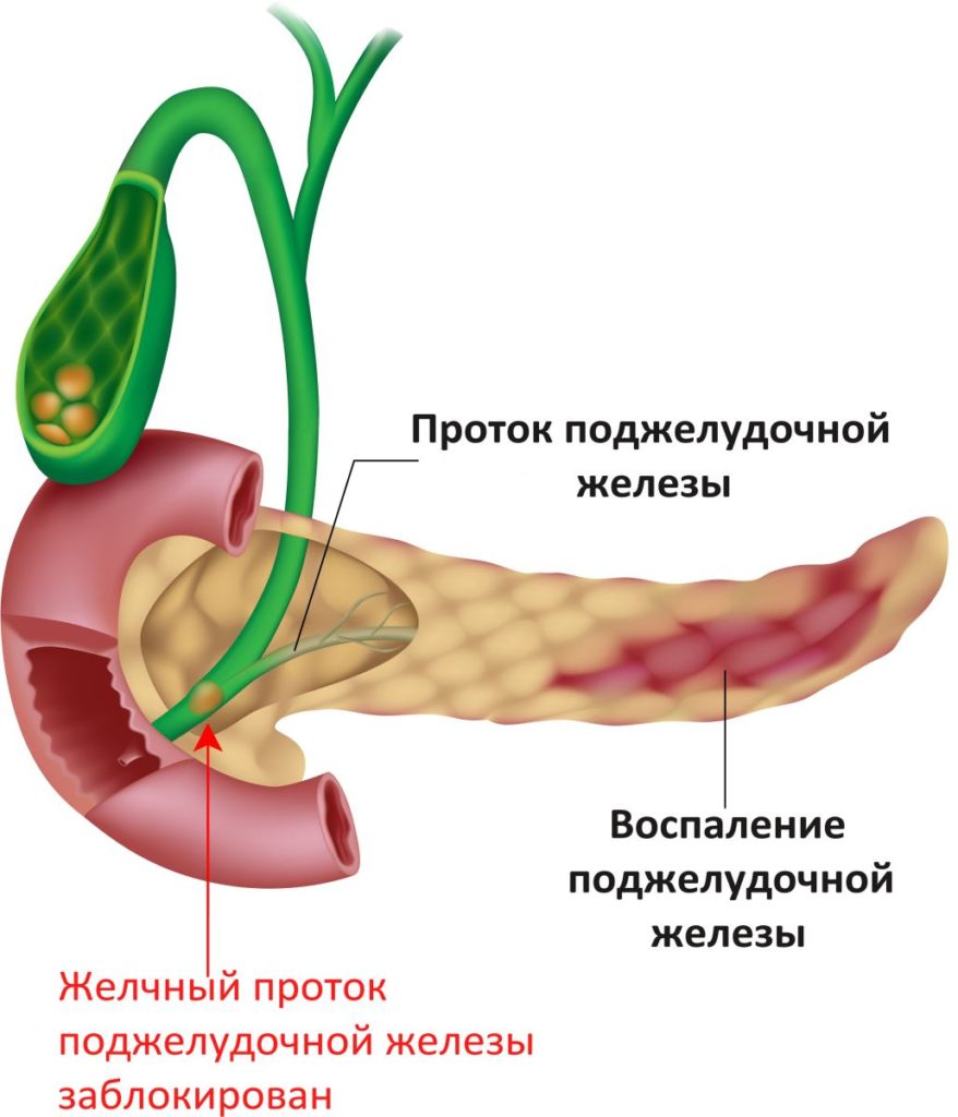 Панкреатит и наследственность: как гены влияют на развитие заболевания