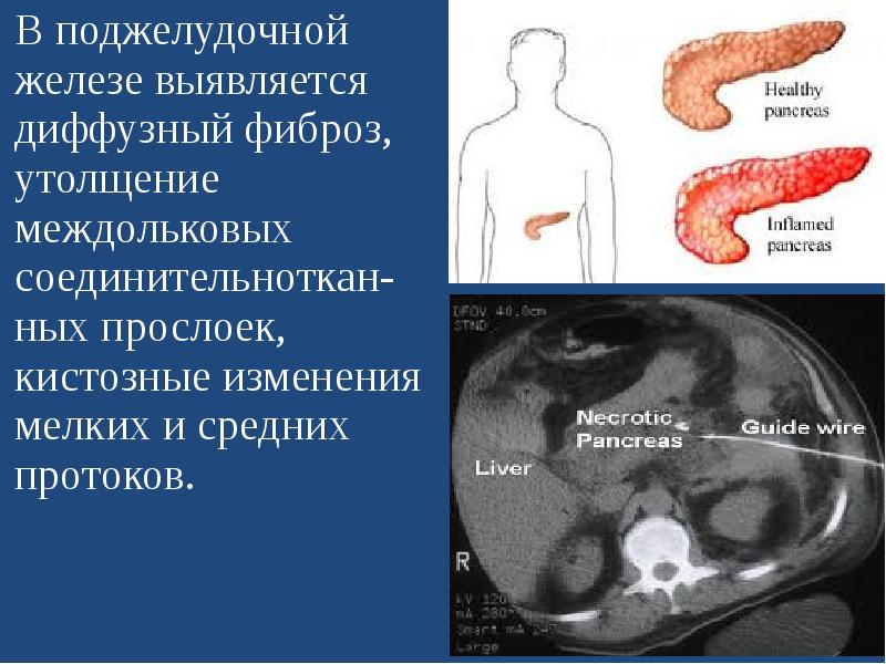 умеренные диффузные изменения поджелудочной железы на vseojkt.ru
