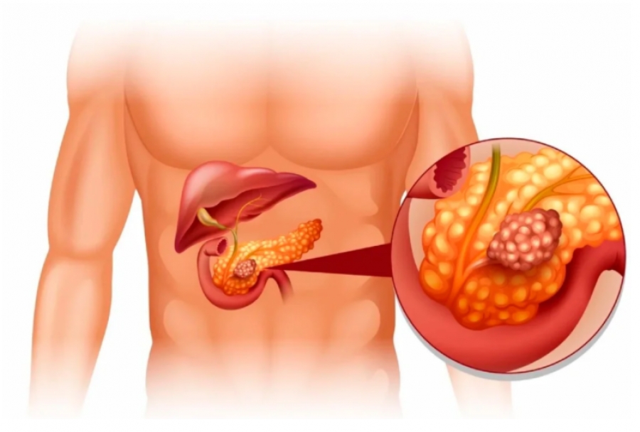 aberrant pancreas перевод