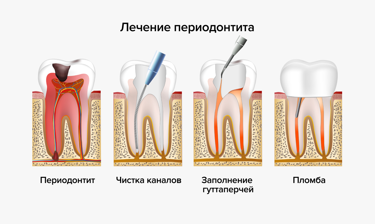 лечениетпериодонтита прополисом