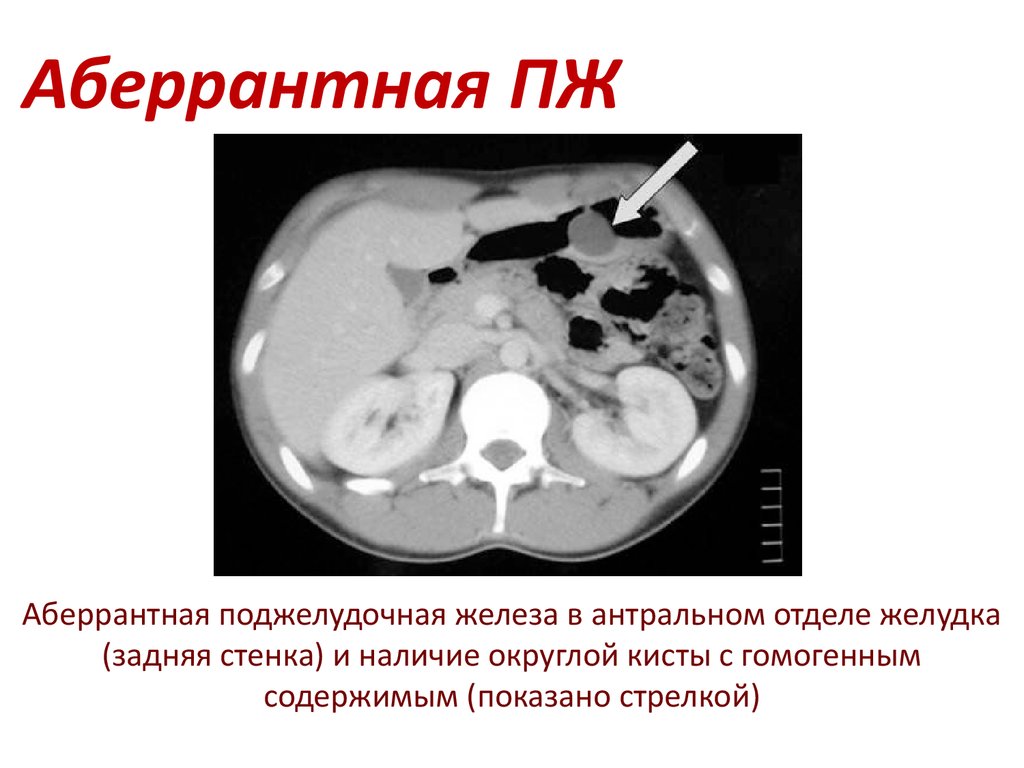 аберрантная поджелудочная железа